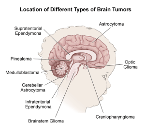 brain-tumors-161407.gif